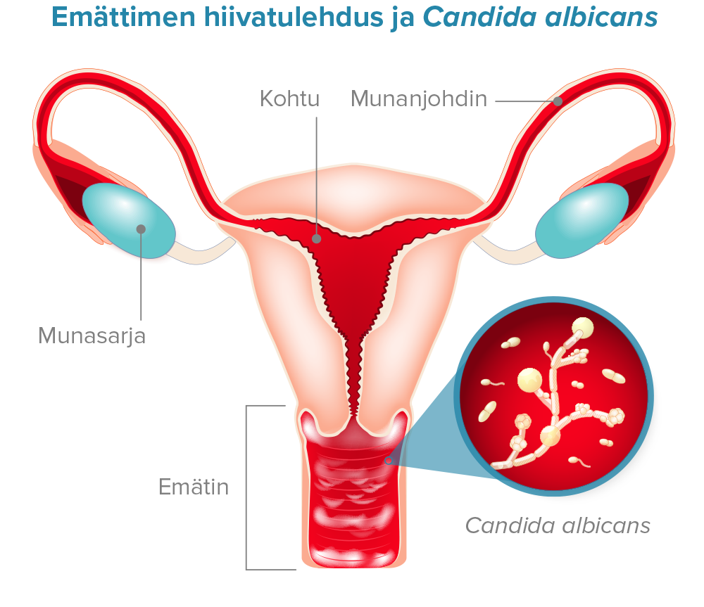 Emättimen hiivatulehdus ja Candida albicans Diagram.